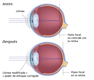 Cirugía Lasik Miopia
