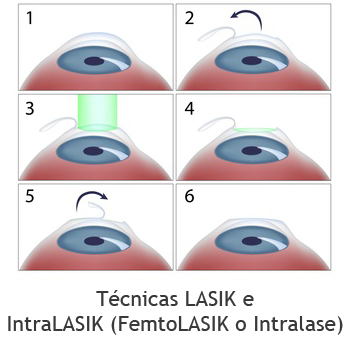 Técnica Lasik