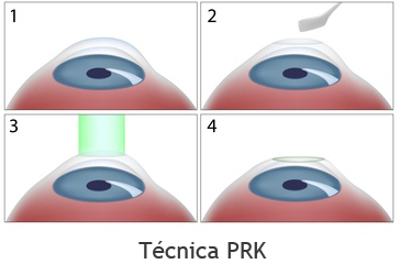 Tecnica PRK